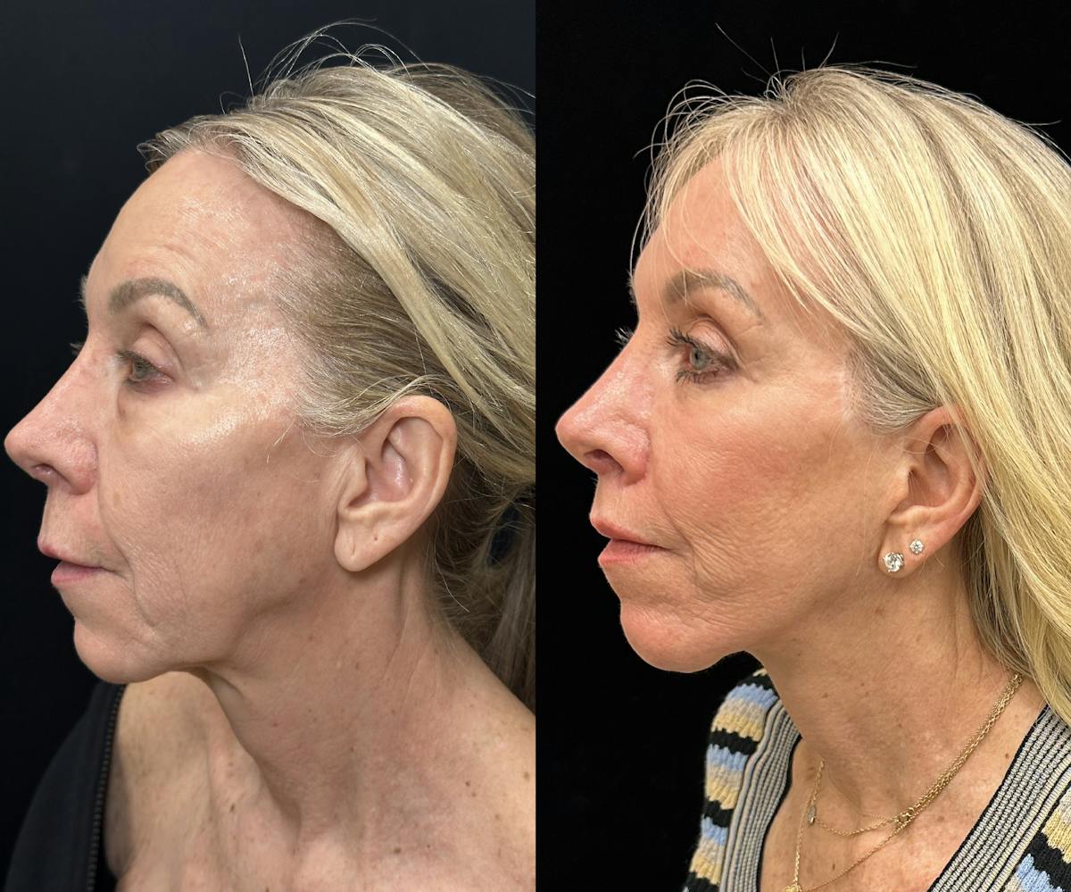 Deep Plane Facelift Before & After Gallery - Patient 533350 - Image 6