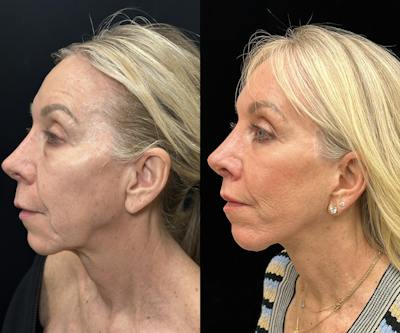 Deep Plane Facelift Before & After Gallery - Patient 533350 - Image 6