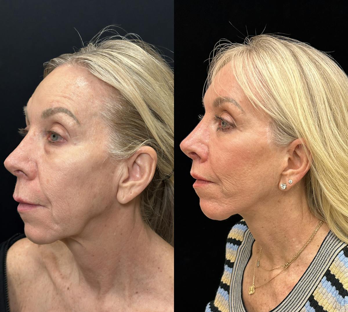 Deep Plane Facelift Before & After Gallery - Patient 533350 - Image 5