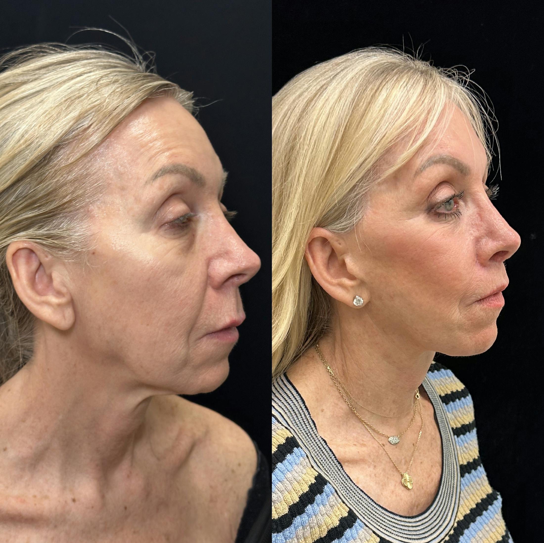 Deep Plane Facelift Before & After Gallery - Patient 533350 - Image 3