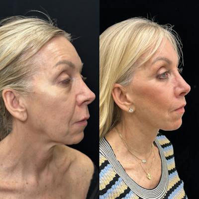 Deep Plane Facelift Before & After Gallery - Patient 533350 - Image 3