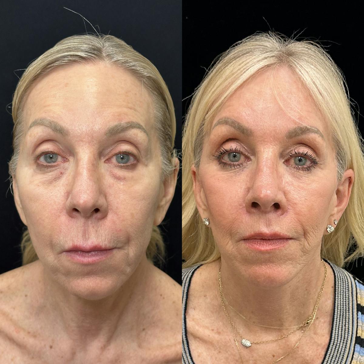 Deep Plane Facelift Before & After Gallery - Patient 533350 - Image 1