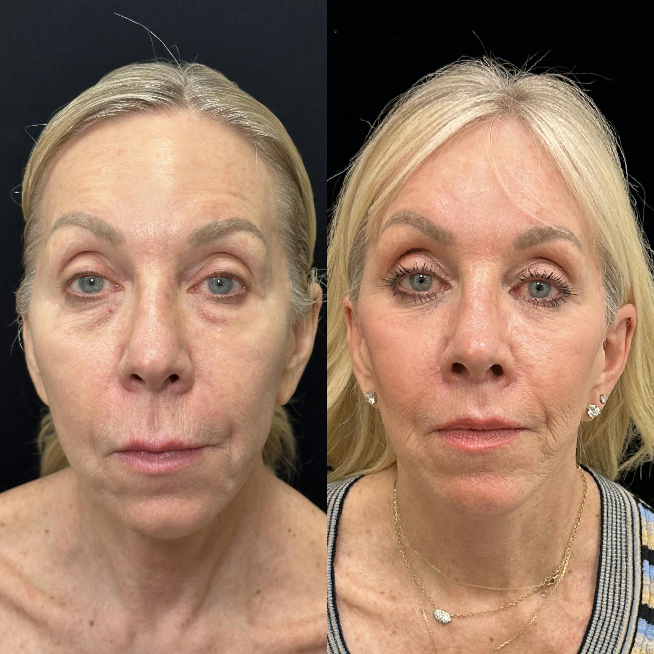 Deep Plane Facelift Before & After Gallery - Patient 533350 - Image 1