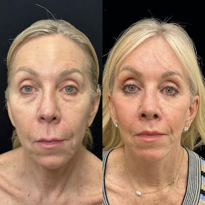 Deep Plane Facelift Before & After Gallery - Patient 533350 - Image 1