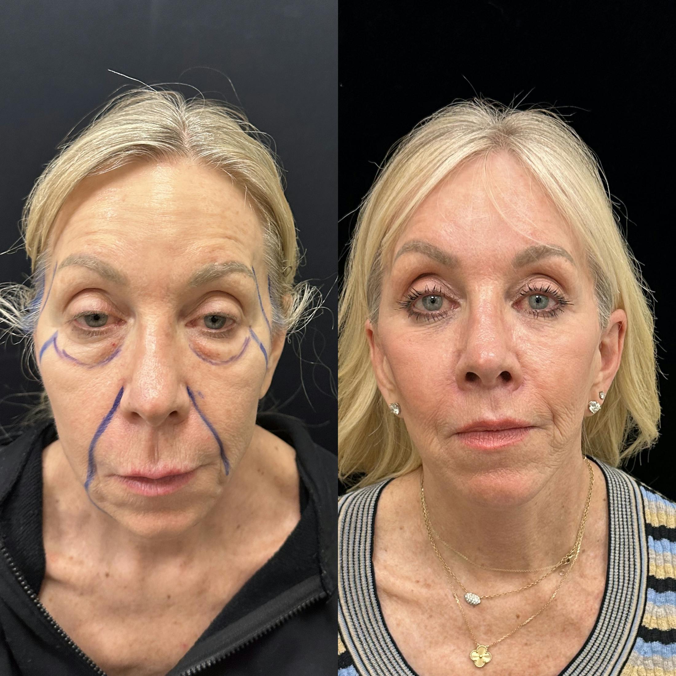 Deep Plane Facelift Before & After Gallery - Patient 533350 - Image 2