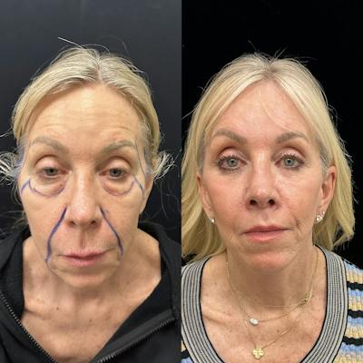 Deep Plane Facelift Before & After Gallery - Patient 533350 - Image 2