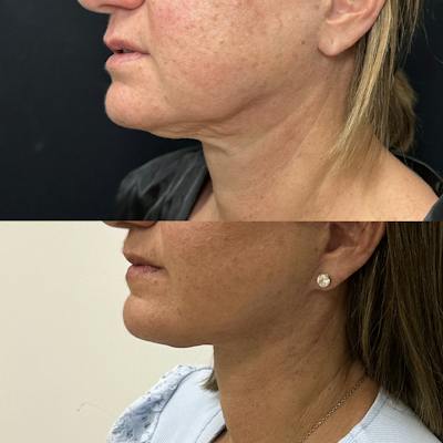 Deep Plane Facelift Before & After Gallery - Patient 515276 - Image 3