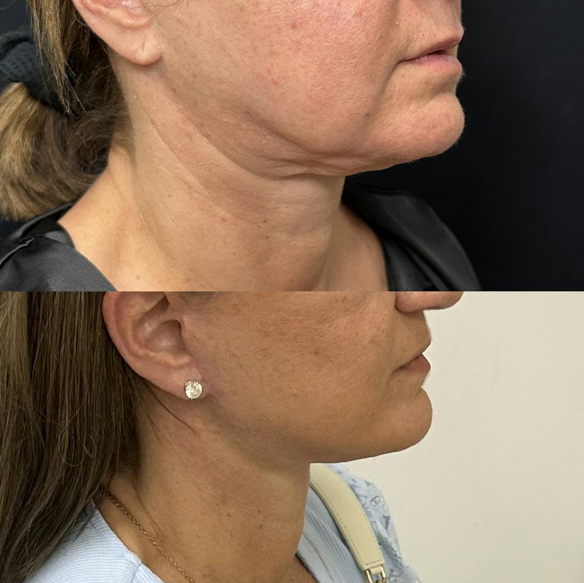 Deep Plane Facelift Before & After Gallery - Patient 515276 - Image 1