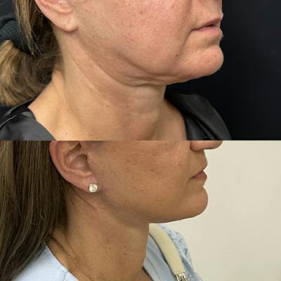 Deep Plane Facelift Before & After Gallery - Patient 515276 - Image 1