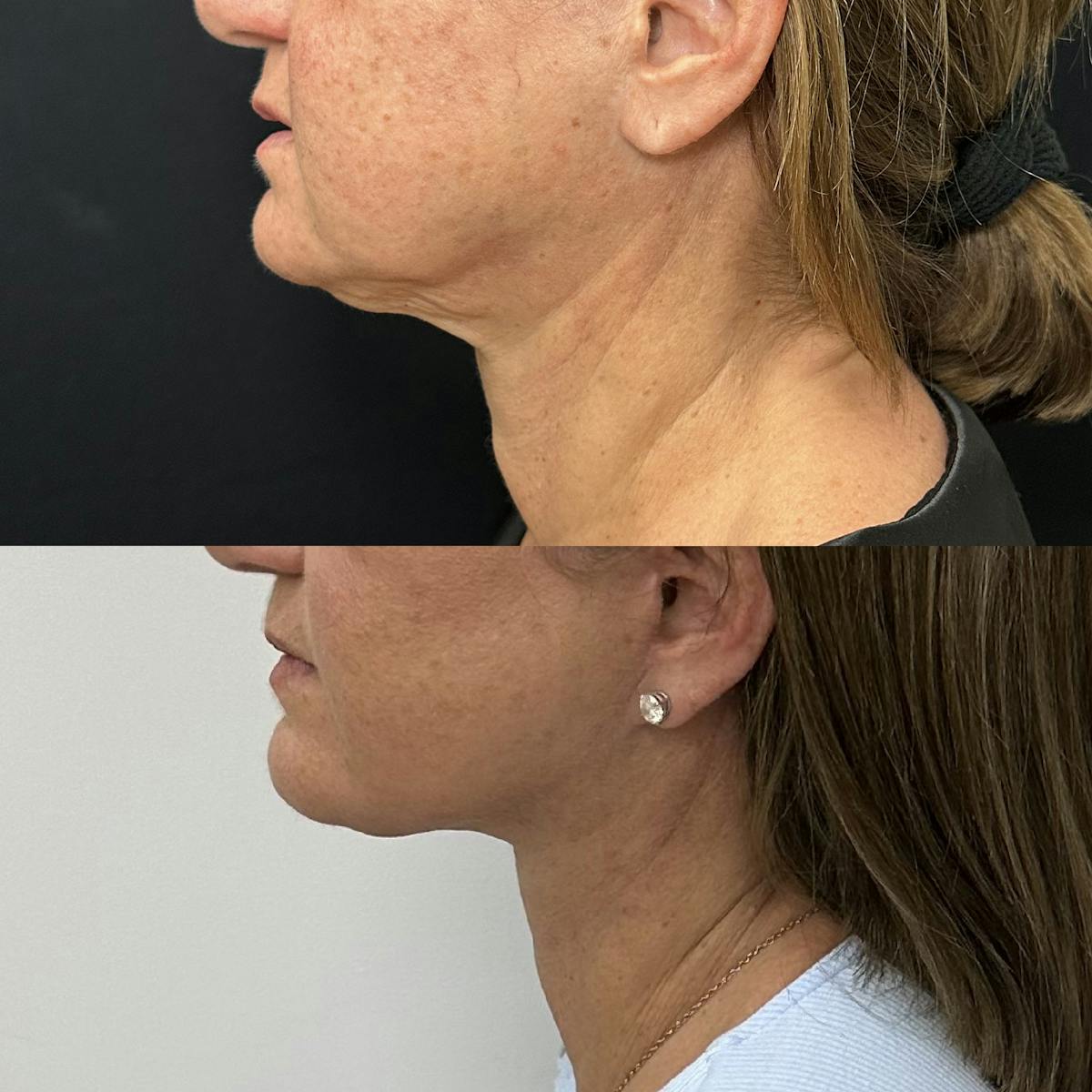 Deep Plane Facelift Before & After Gallery - Patient 515276 - Image 4