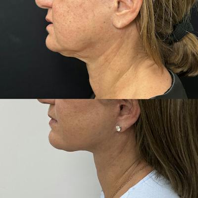 Deep Plane Facelift Before & After Gallery - Patient 515276 - Image 4