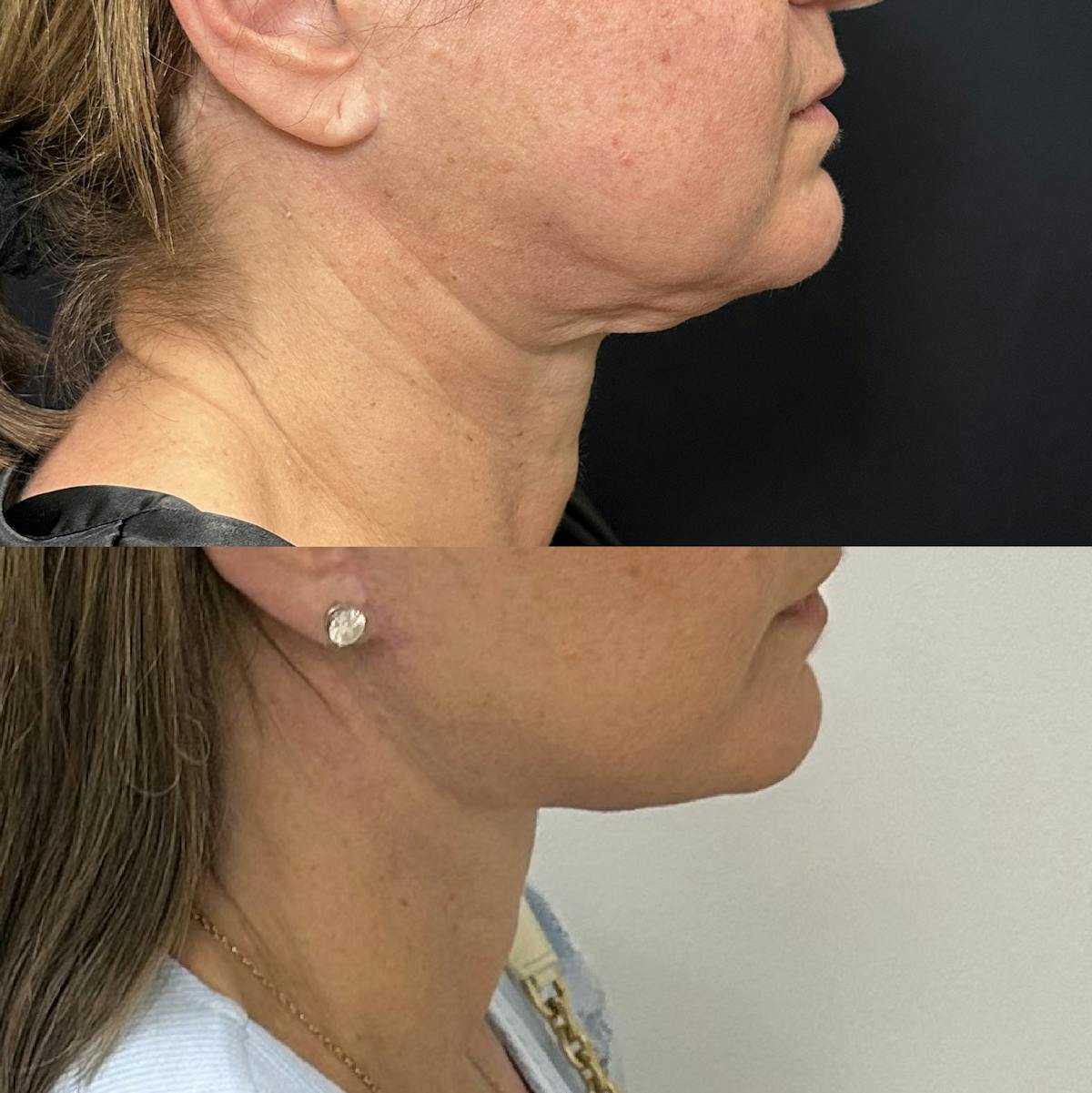 Deep Plane Facelift Before & After Gallery - Patient 515276 - Image 2