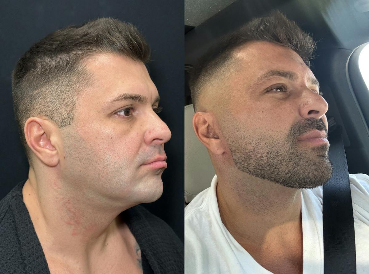 Deep Plane Facelift Before & After Gallery - Patient 293718 - Image 1