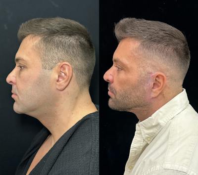 Deep Plane Facelift Before & After Gallery - Patient 293718 - Image 4