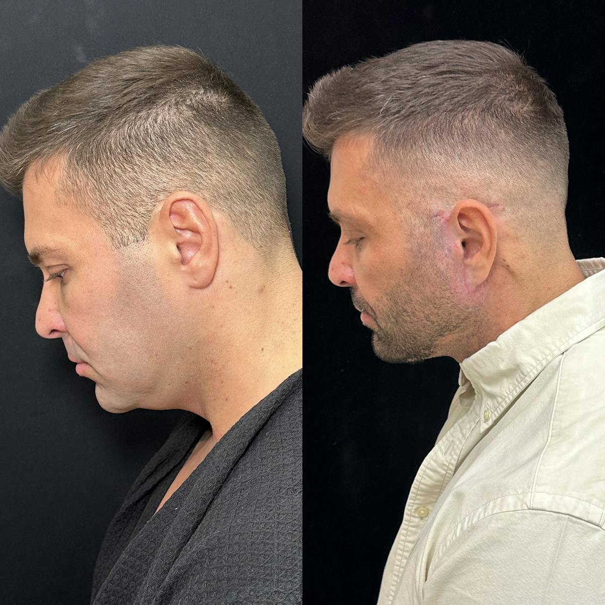 Deep Plane Facelift Before & After Gallery - Patient 293718 - Image 5