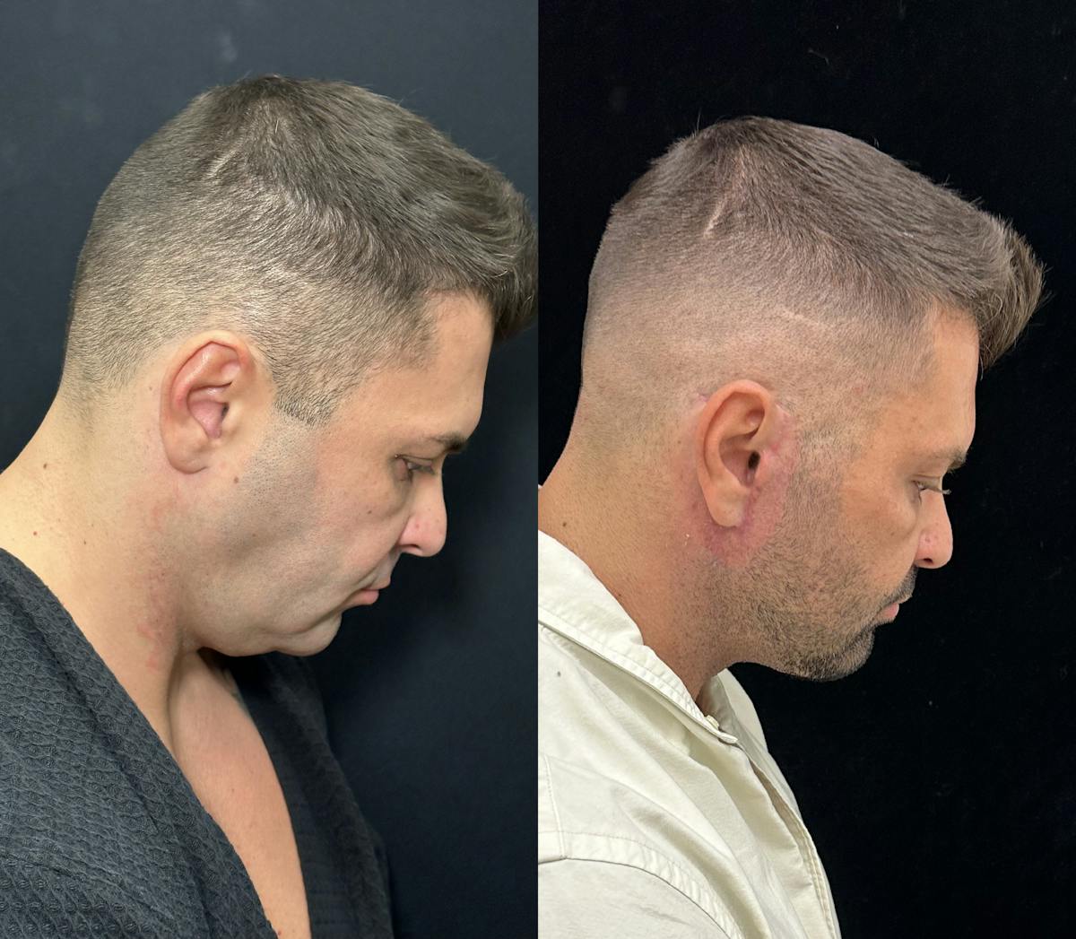 Deep Plane Facelift Before & After Gallery - Patient 293718 - Image 3