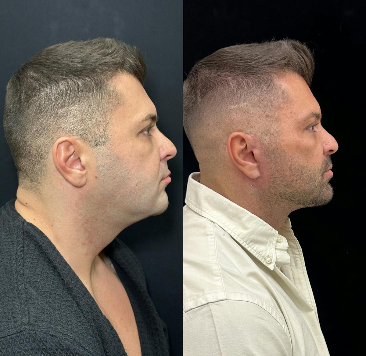 Deep Plane Facelift Before & After Gallery - Patient 293718 - Image 2