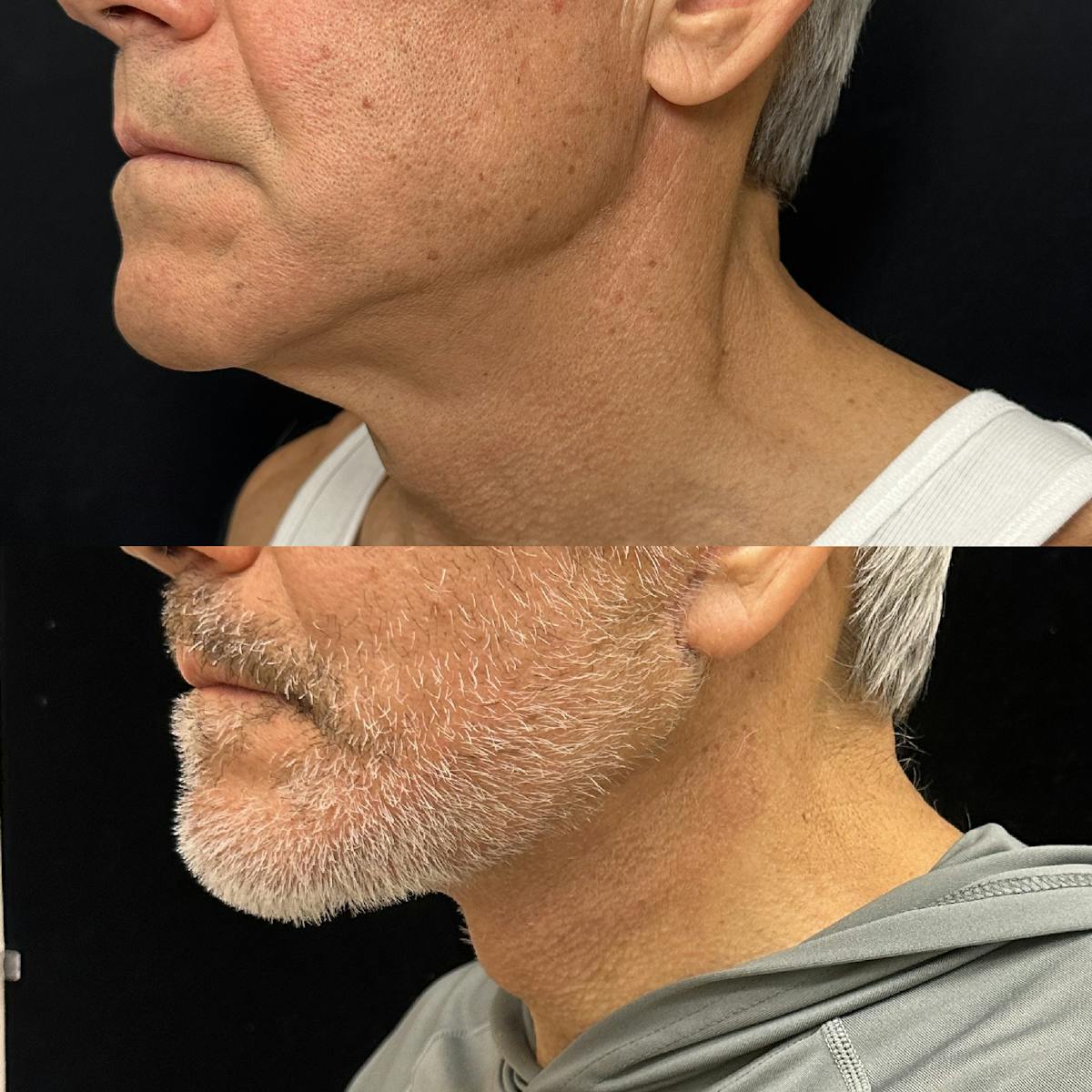 Deep Plane Facelift Before & After Gallery - Patient 383483 - Image 3