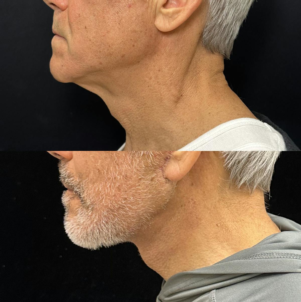 Deep Plane Facelift Before & After Gallery - Patient 383483 - Image 4