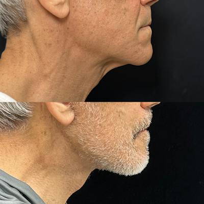 Deep Plane Facelift Before & After Gallery - Patient 383483 - Image 2