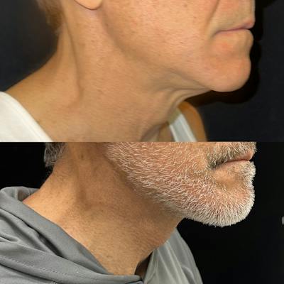 Deep Plane Facelift Before & After Gallery - Patient 383483 - Image 1