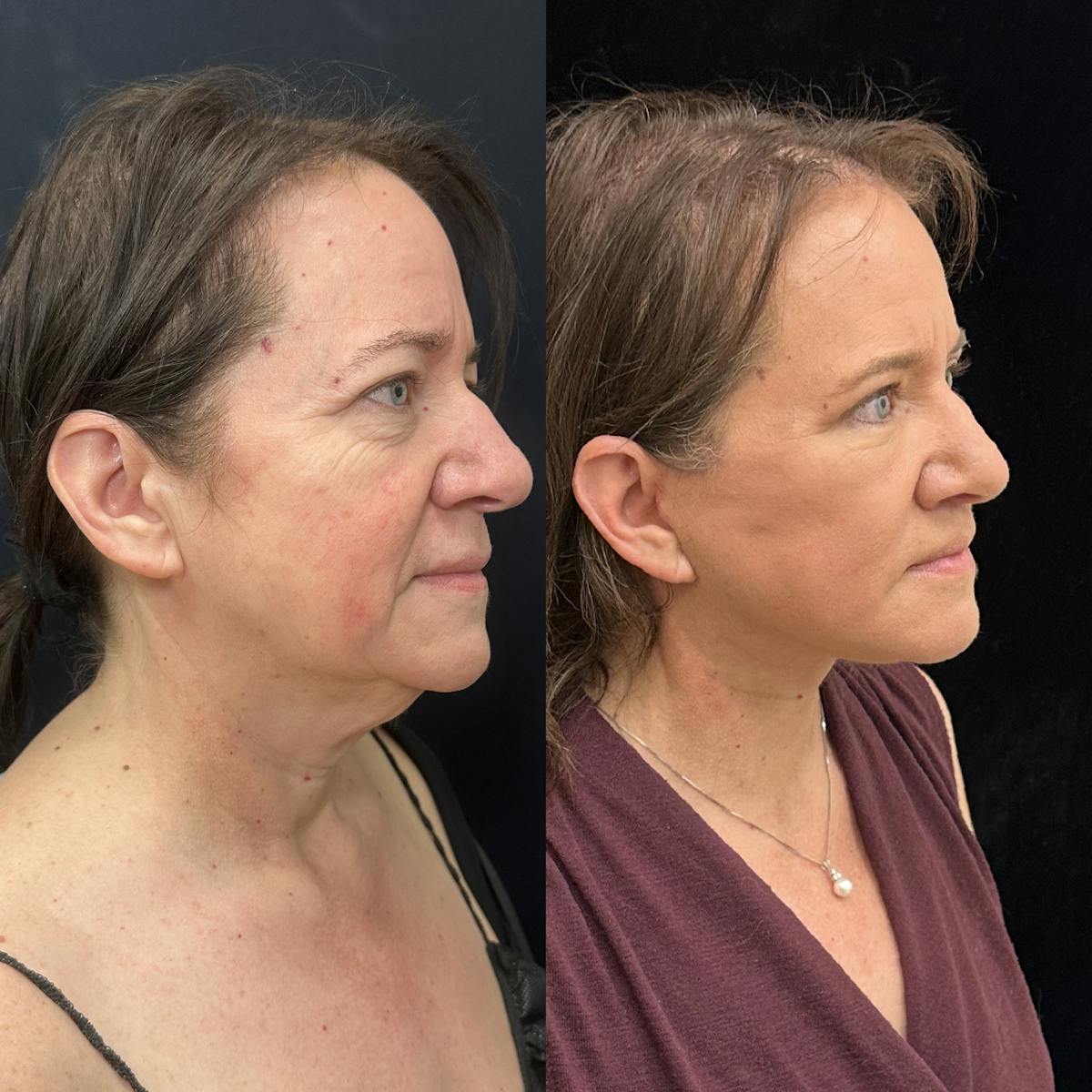 Deep Plane Facelift Before & After Gallery - Patient 396679 - Image 1