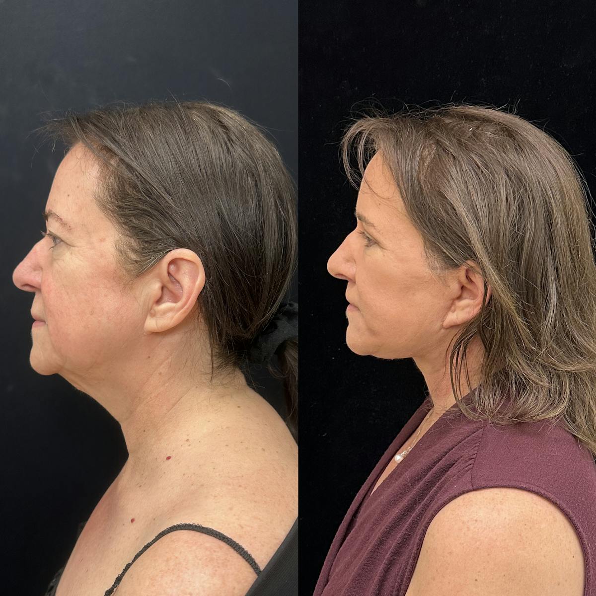 Deep Plane Facelift Before & After Gallery - Patient 396679 - Image 3