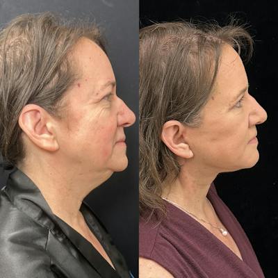 Deep Plane Facelift Before & After Gallery - Patient 396679 - Image 2