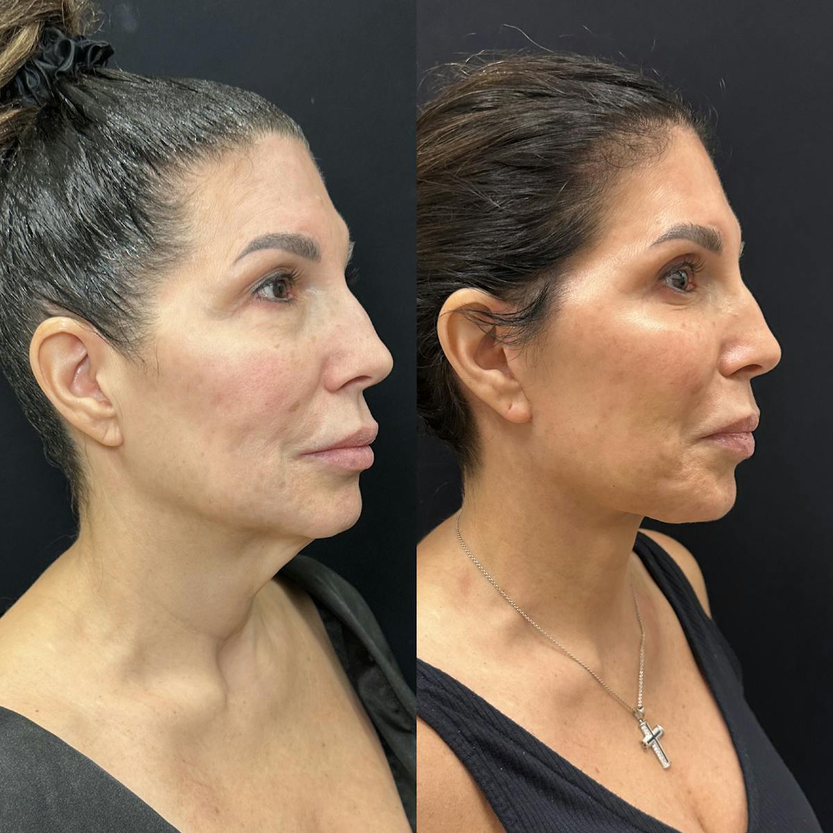 Deep Plane Facelift Before & After Gallery - Patient 123091 - Image 1