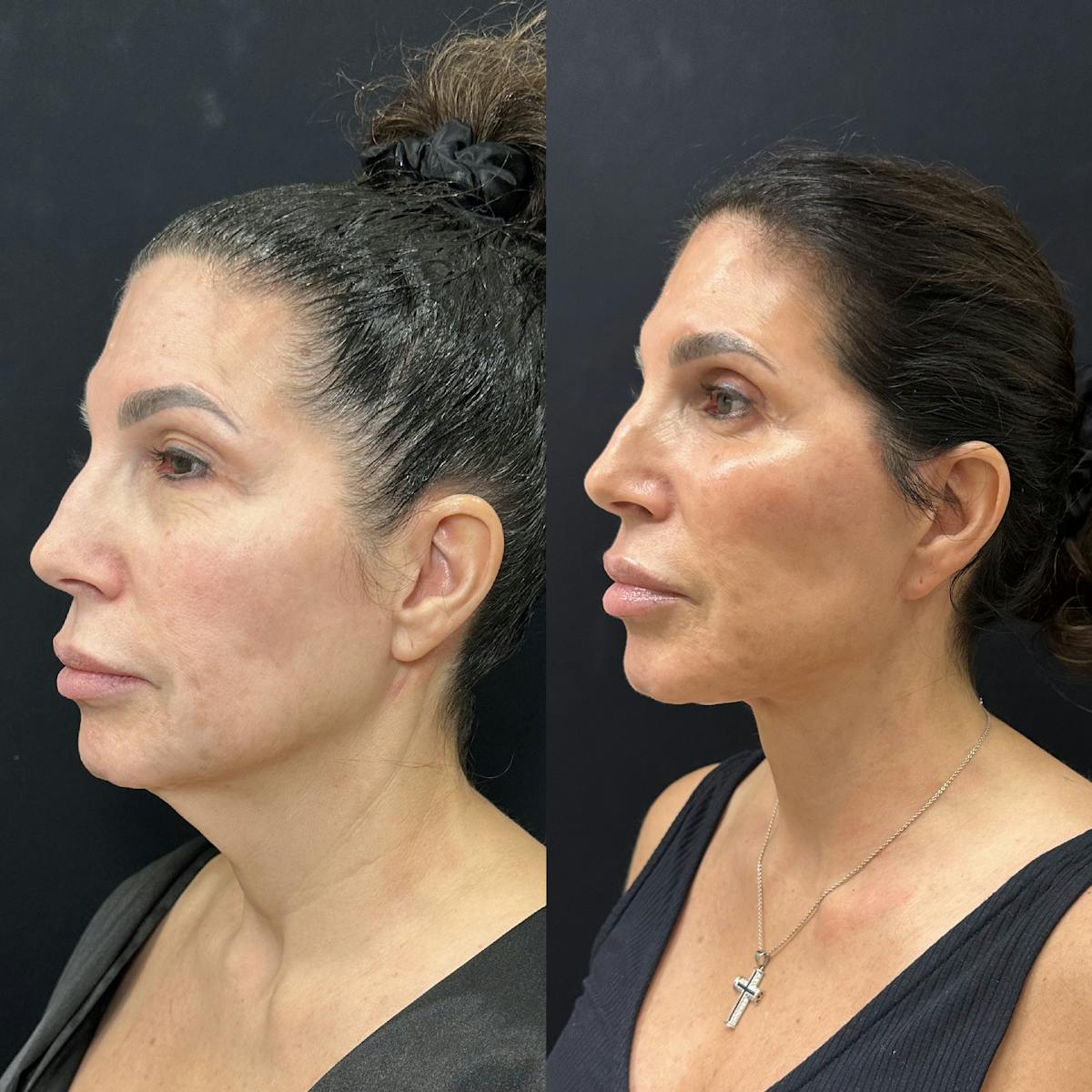 Deep Plane Facelift Before & After Gallery - Patient 123091 - Image 4