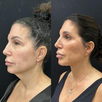 Deep Plane Facelift Before & After Gallery - Patient 123091 - Image 4
