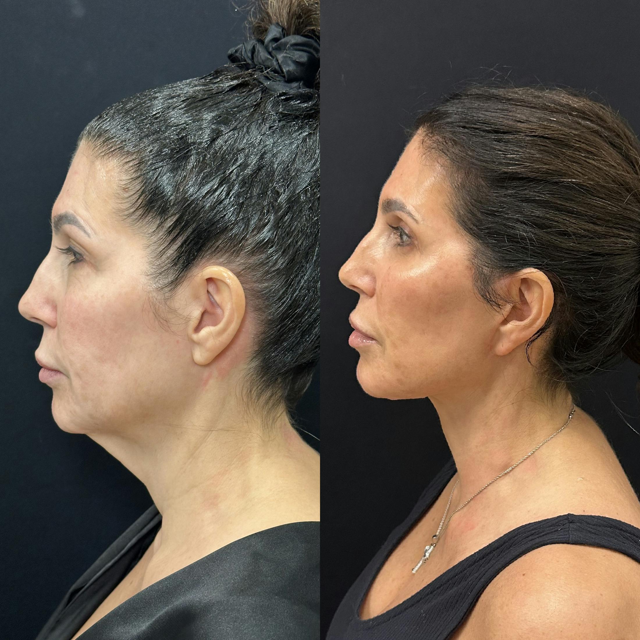 Deep Plane Facelift Before & After Gallery - Patient 123091 - Image 5
