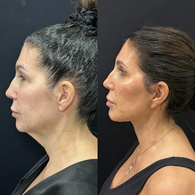 Deep Plane Facelift Before & After Gallery - Patient 123091 - Image 5