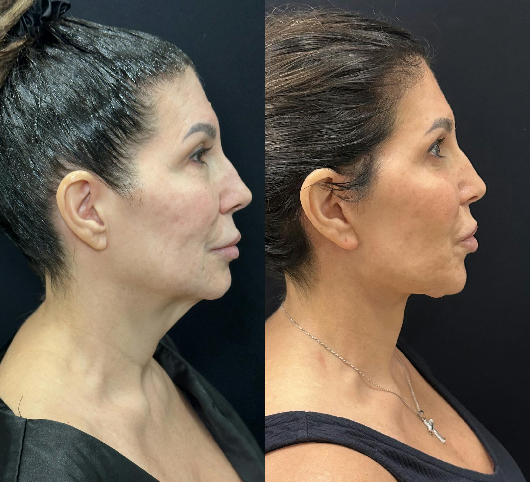 Deep Plane Facelift Before & After Gallery - Patient 123091 - Image 2