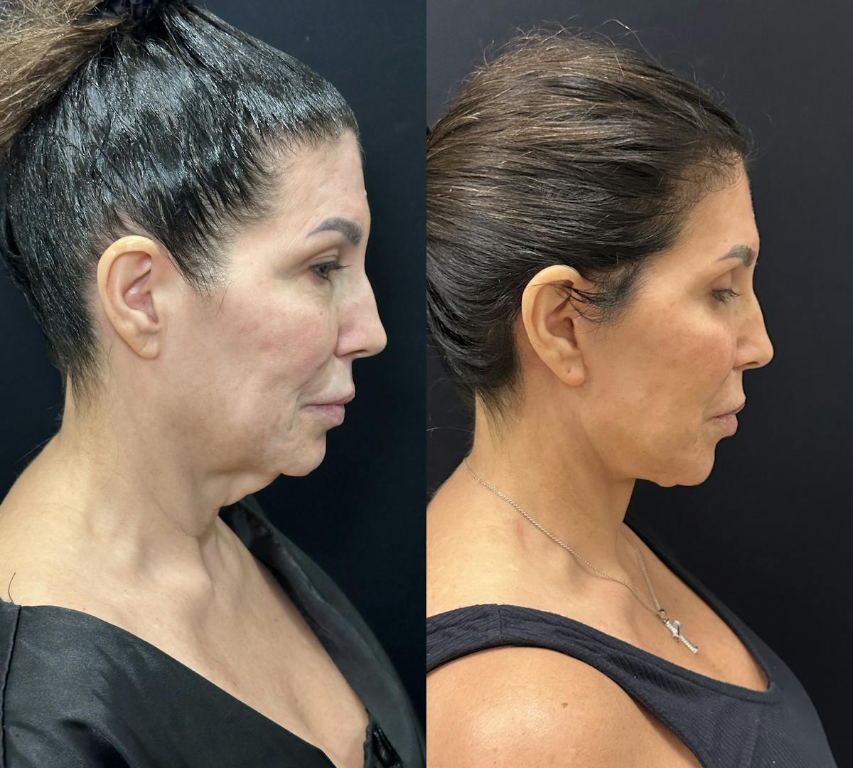 Deep Plane Facelift Before & After Gallery - Patient 123091 - Image 3