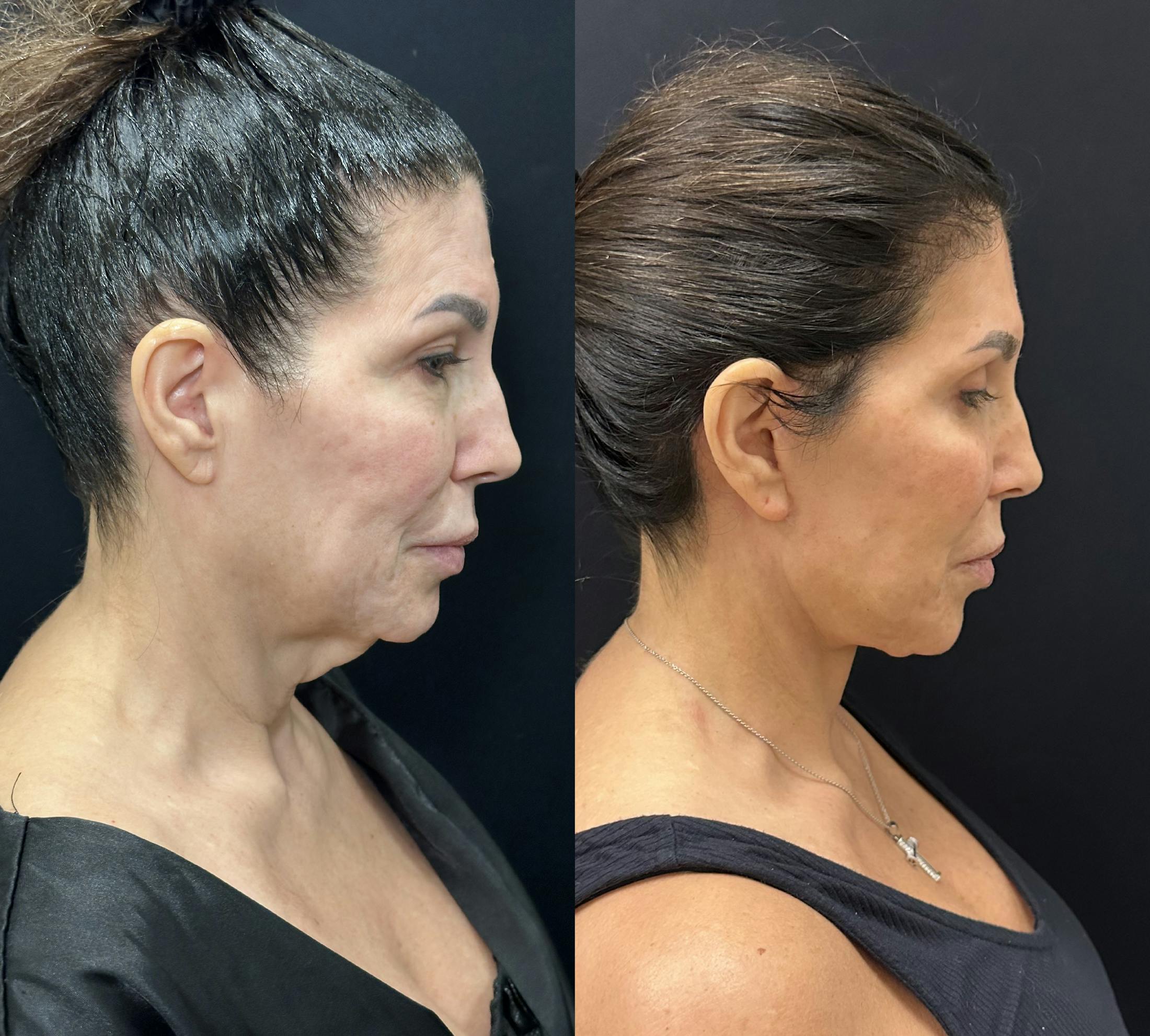 Deep Plane Facelift Before & After Gallery - Patient 123091 - Image 3