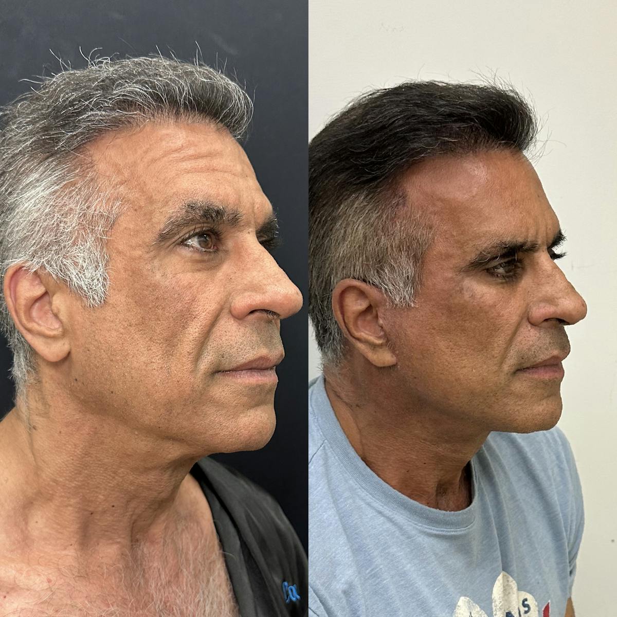 Deep Plane Facelift Before & After Gallery - Patient 124063 - Image 2