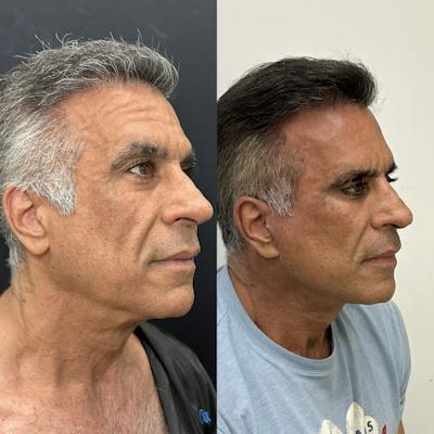 Deep Plane Facelift Before & After Gallery - Patient 124063 - Image 2