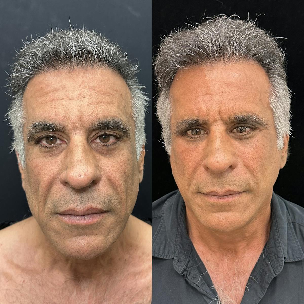 Deep Plane Facelift Before & After Gallery - Patient 124063 - Image 1