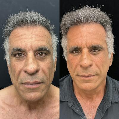 Deep Plane Facelift Before & After Gallery - Patient 124063 - Image 1