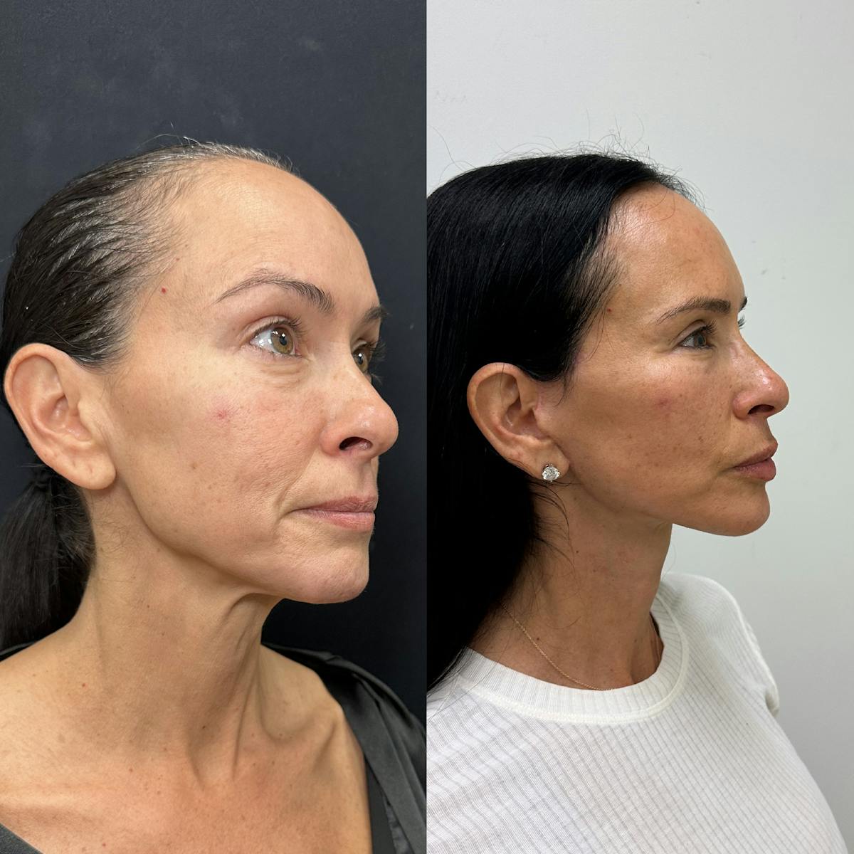 Deep Plane Facelift Before & After Gallery - Patient 373978 - Image 1