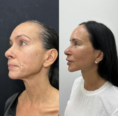 Deep Plane Facelift Before & After Gallery - Patient 373978 - Image 4
