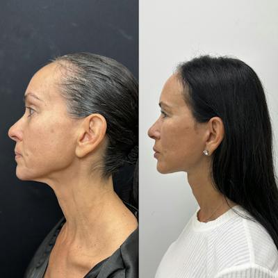 Deep Plane Facelift Before & After Gallery - Patient 373978 - Image 5