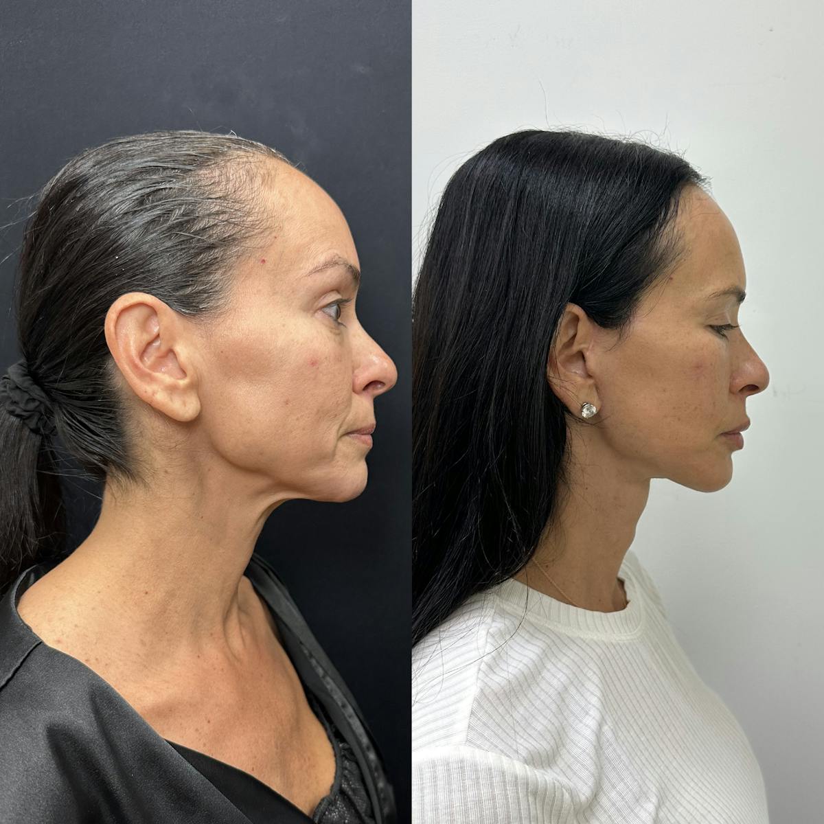 Deep Plane Facelift Before & After Gallery - Patient 373978 - Image 2