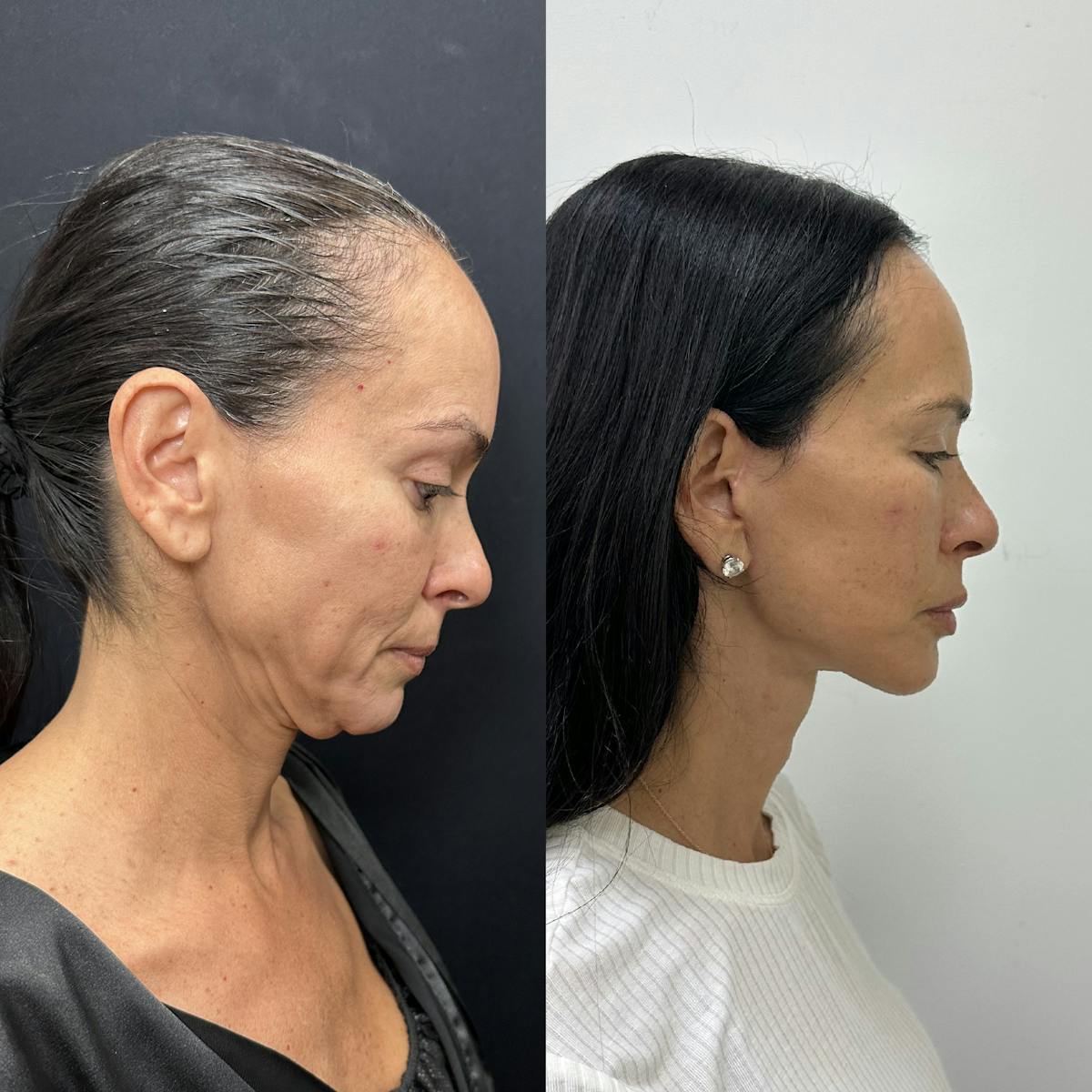 Deep Plane Facelift Before & After Gallery - Patient 373978 - Image 3