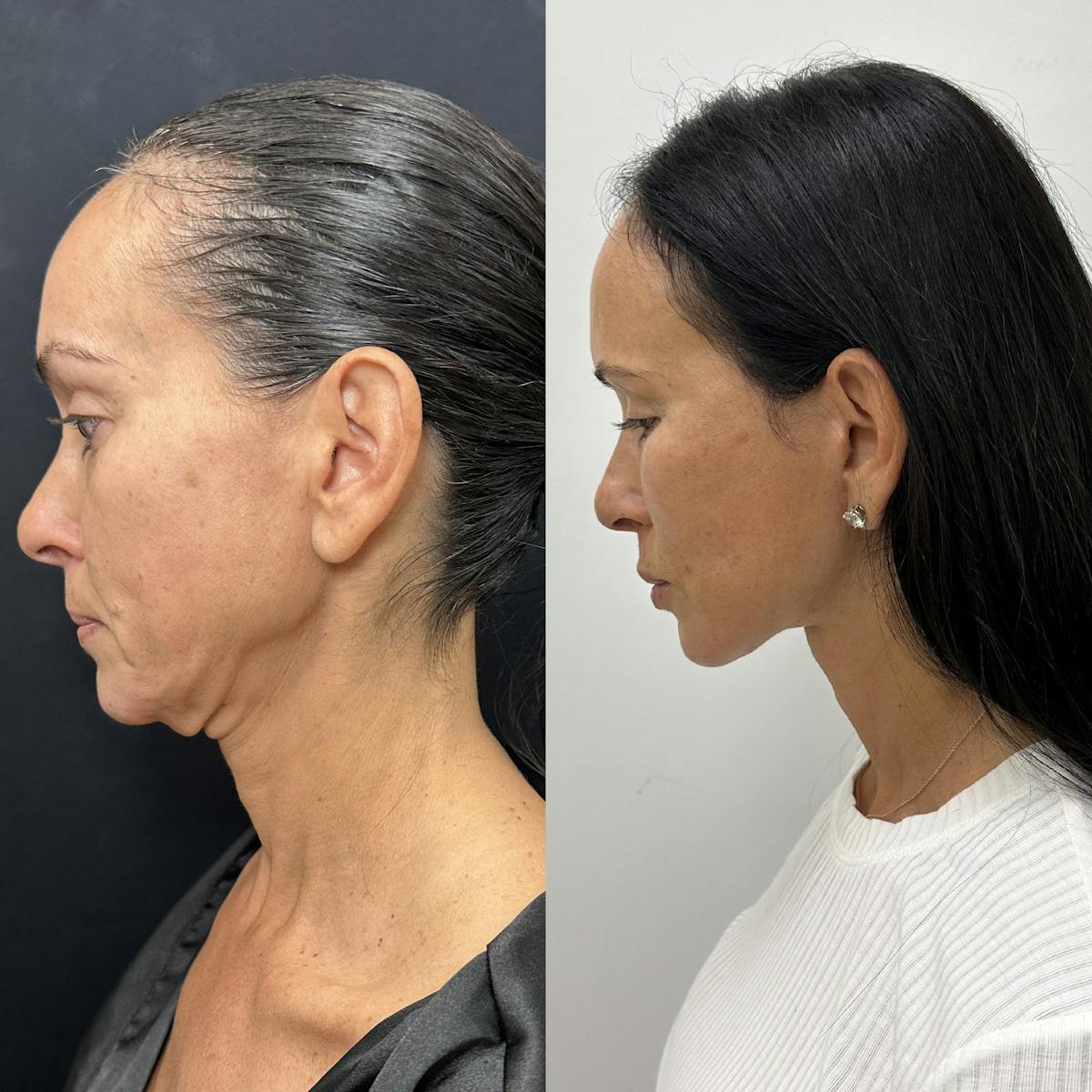 Deep Plane Facelift Before & After Gallery - Patient 373978 - Image 6