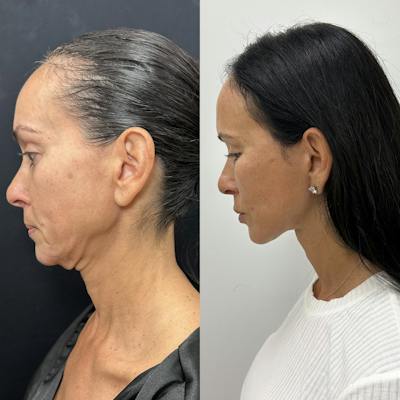 Deep Plane Facelift Before & After Gallery - Patient 373978 - Image 6