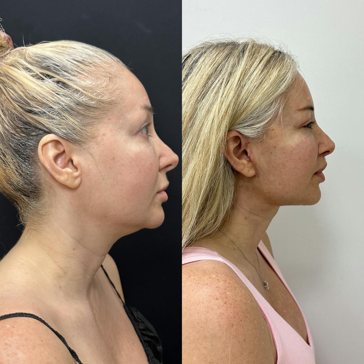 Deep Plane Facelift Before & After Gallery - Patient 406072 - Image 3