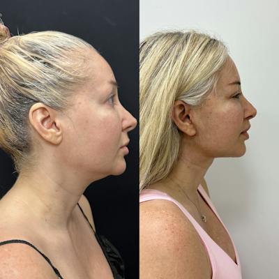 Deep Plane Facelift Before & After Gallery - Patient 406072 - Image 3