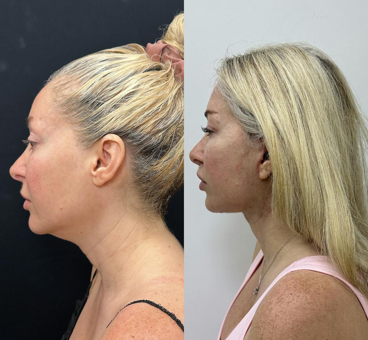 Deep Plane Facelift Before & After Gallery - Patient 406072 - Image 1